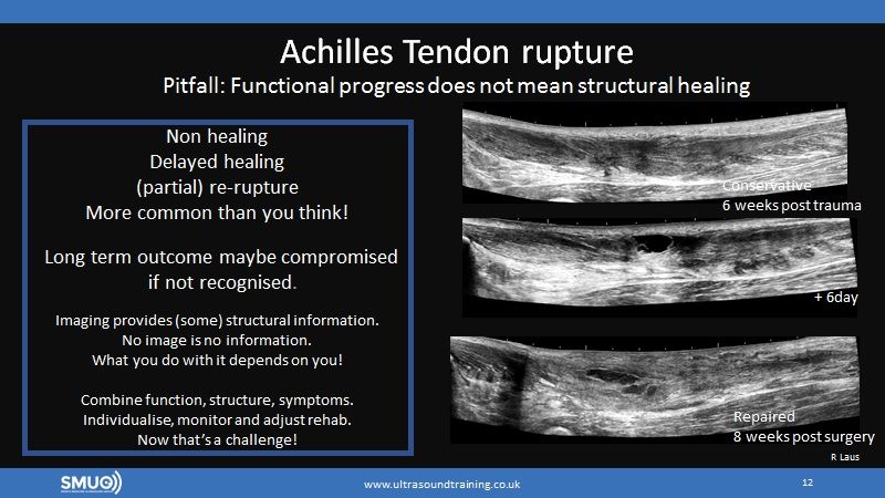 SMUGcourses's tweet photo. Post achiles rupture, is #MSKUS required?  Functional testing, symptoms presentation do not identify structural problems.When high level sports performance is required, failing to identify structural problems can compromise (long-term) functional outcome. #achilles #POCUS https://t.co/QjvQuwxn8V