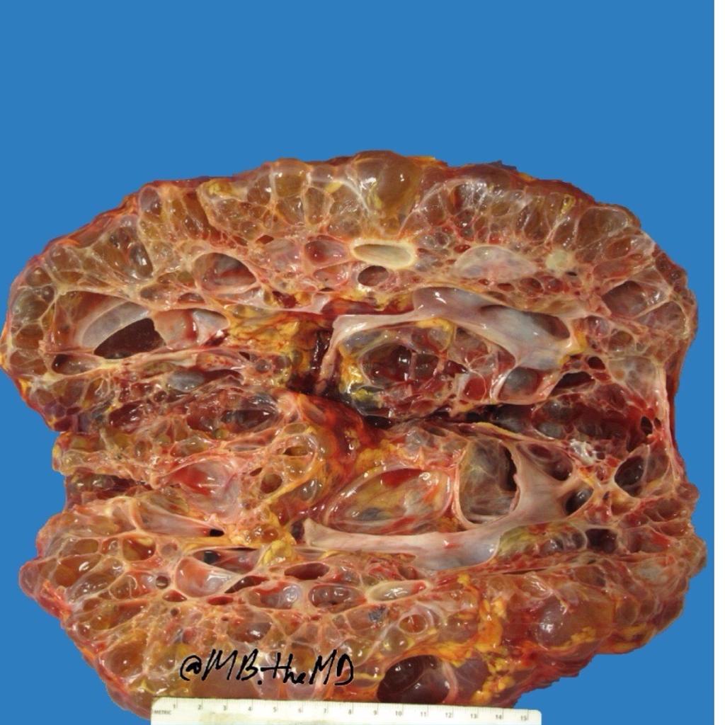 MB_thepathMD's tweet photo. #Grossnosis #pathology https://t.co/TqUQhJJvGn