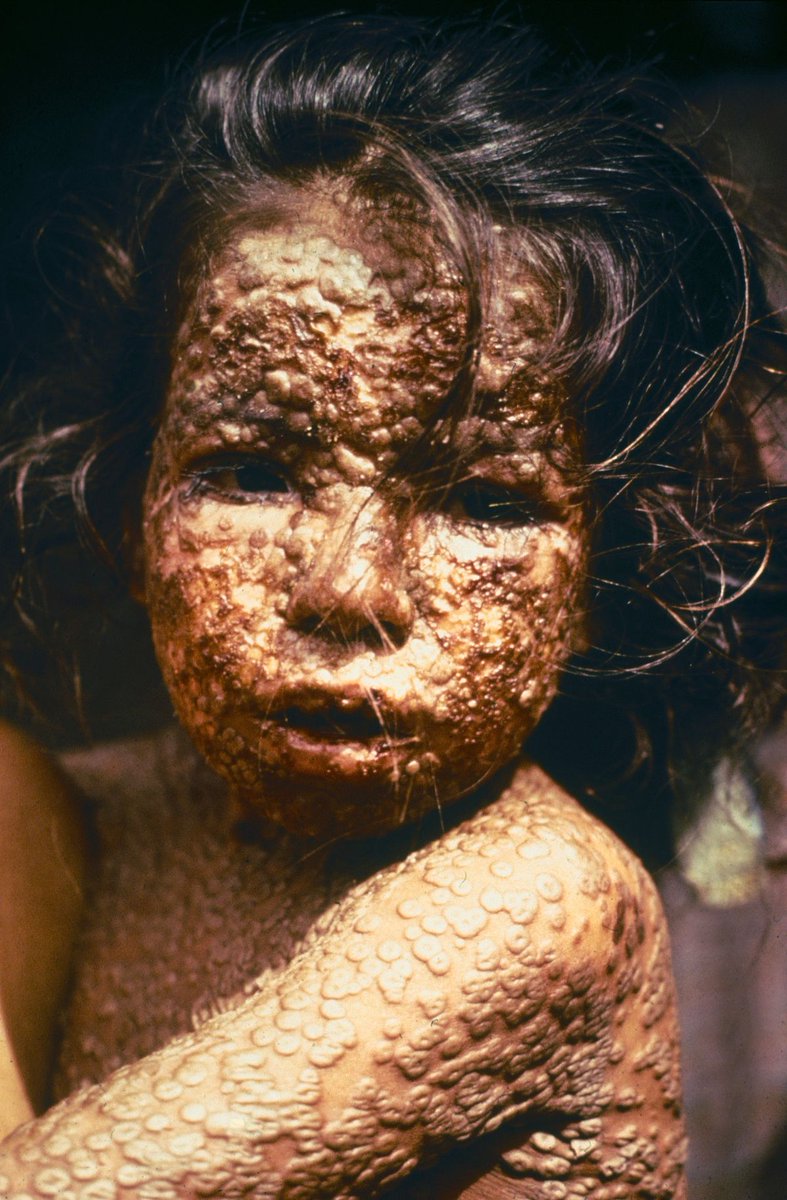 Smallpox was one of the worst killers in our history. In the last hundred years of its existence smallpox killed at least half a billion people.Even more people were disfigured and blinded by the disease for the rest of their lives.