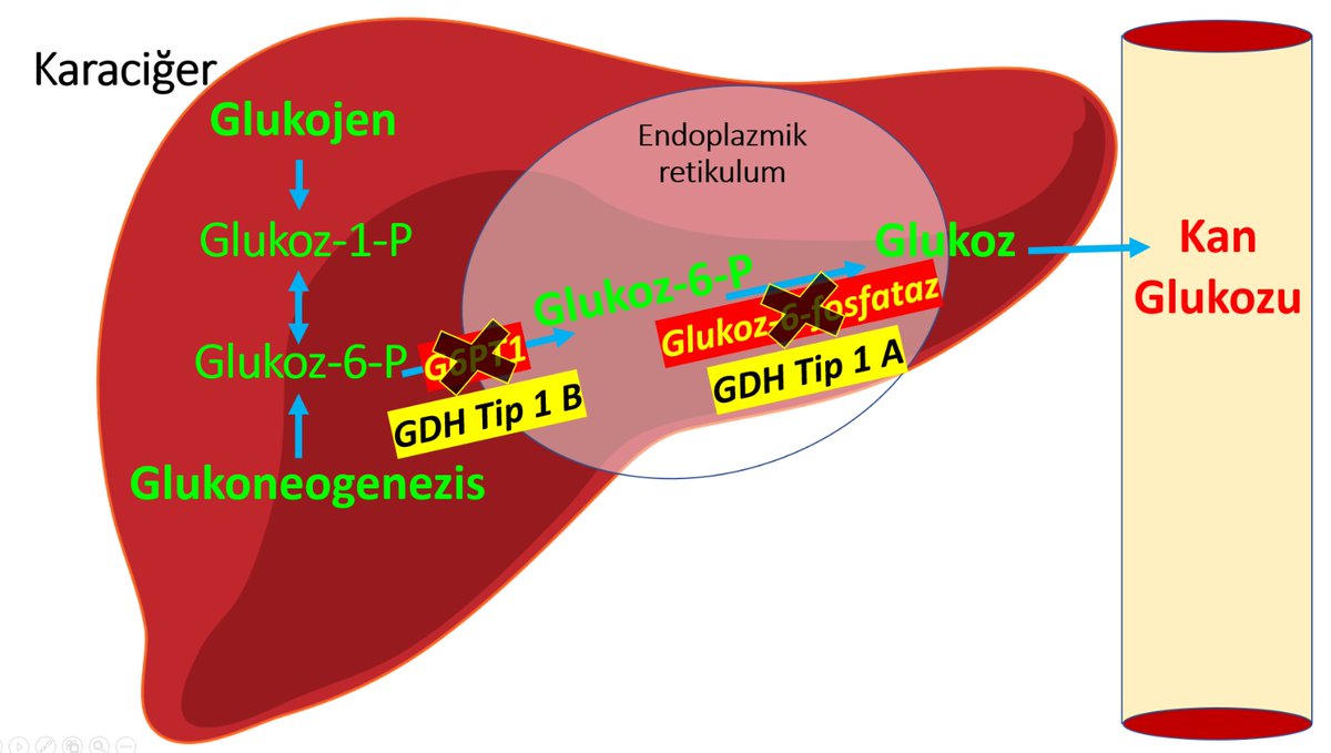 atgen2020's tweet photo. ÖZET VE TAVSİYELER
●Glikoz6fosfataz eksikliği (G6PD);glikojen depo hastalığı tip I,veya von Gierke hastalığı olarak bilinir.
Glukoz6fosfat (G6P) hidrolaz(tip Ia) veya G6P translokaz(tip Ib) mutasyonlarından kaynaklanan otozomal resesif bir hastalıktır.@RaDiChallenge @GDH_GSD https://t.co/qomNrdIe3p