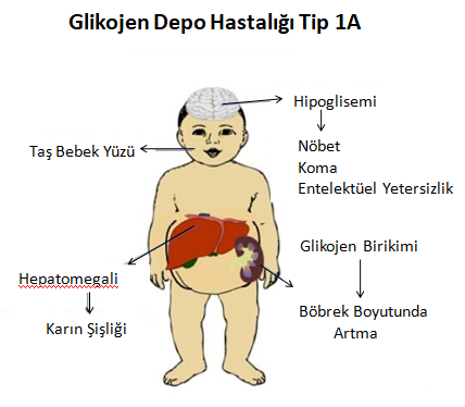 atgen2020's tweet photo. ●Hastalar erken bebeklik döneminde büyüme geriliği, hepatomegali, hipoglisemi, nöbetler ve laktik asidoz ile başvururlar.Ek belirtiler arasında böbrek hastalıkları,hiperürisemi, hipertrigliseridemi ve tip Ib'li hastalarda nötropeniye bağlı tekrarlayan enfeksiyonlar bulunur. https://t.co/eqW0T87PrK
