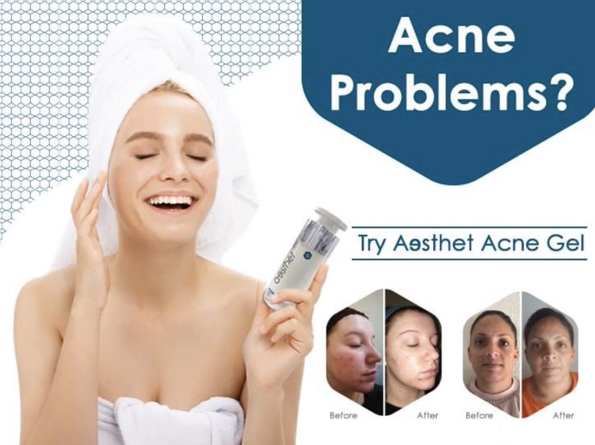 essel_skin's tweet photo. Acne can happen at anytime of the year however it is more common during the hotter and sweatier months - Aesthet Acne Gel #acne #acnetreatment #acnepositivity #acneremoval #acneproblems #acneskincare #acnefree #acnecommunity #acnetips #acnehelp #acnejourney #acnesolution https://t.co/9yorP0DbiR