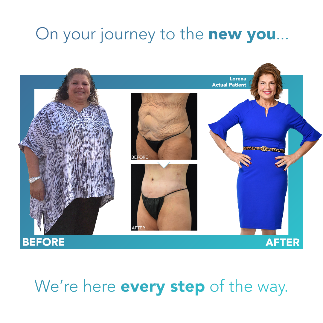 DrKevinSmall's tweet photo. After her amazing success with weight-loss surgery, Lorena’s lower body lift helped her feel even more confident than ever before! See more patient results: https://t.co/fUz1zdV73H
#NYBGPlasticSurgery #PlasticSurgeryAfterWeightLoss #StayHealthy  #DrKevinSmall #LowerBodyLift https://t.co/wDS2boHcz7