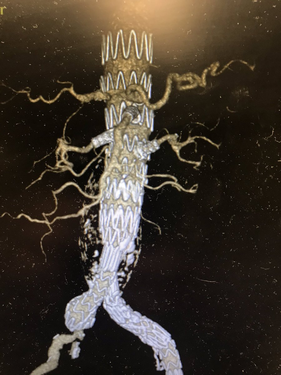 cfbechara's tweet photo. I am proud to be part of the Loyola team @msoultmd offering complex endoVascular aneurysm repair to our heroes and our veterans AND doing them at the Hines VA @HinesVAH with low radiation @GEHealthcare @CookMedical @LoyolaSurgery @LoyolaVascular https://t.co/kLNqv5Cciv