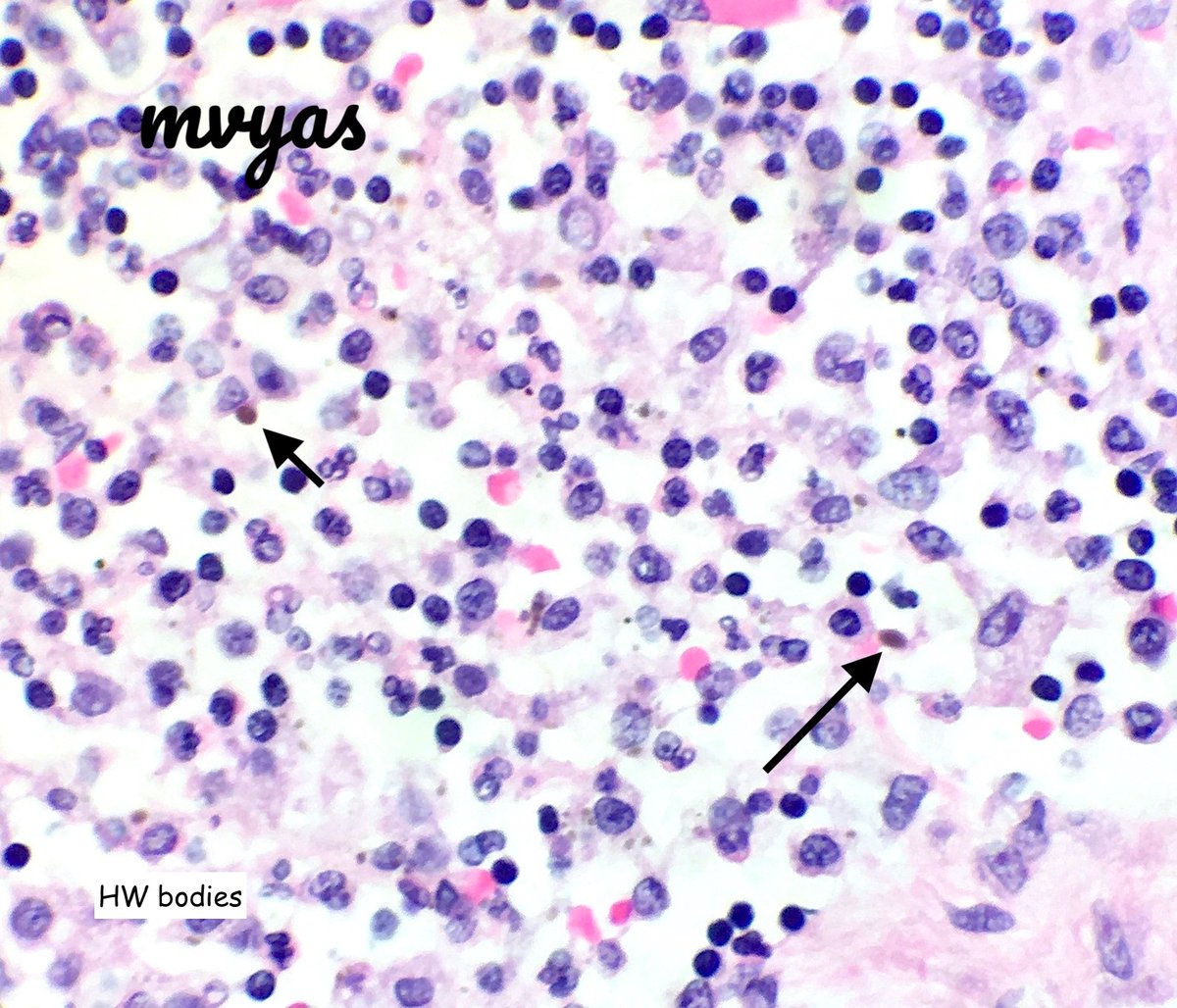 Buzzwords for  #pathboards 
Schaumann body- concentric, lamellated calcification (w/ carbonate and Fe)
Hamazaki-Wesenberg (HW) - Yellow brown, giant lysosomes/ ceroid- yeast-like
-->Not specific for sarcoidosis, can be seen in any chronic granulomatous condition or otherwise