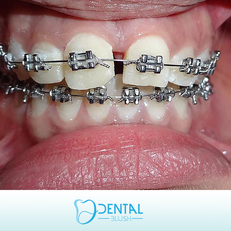 Артикул с вб на брекеты. Брекеты сапфировые damon clear. Брекеты спринт. Артикул с вб на брекеты. Сапфировая брекет-система inspire ice.