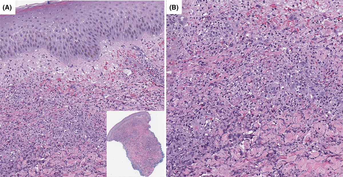 Just out 💥💥 Atypical necrotizing #SweetSyndrome in patients w/MDS &amp; AML  #leusm #hemepath #dermpath onlinelibrary.wiley.com/doi/10.1111/bj…