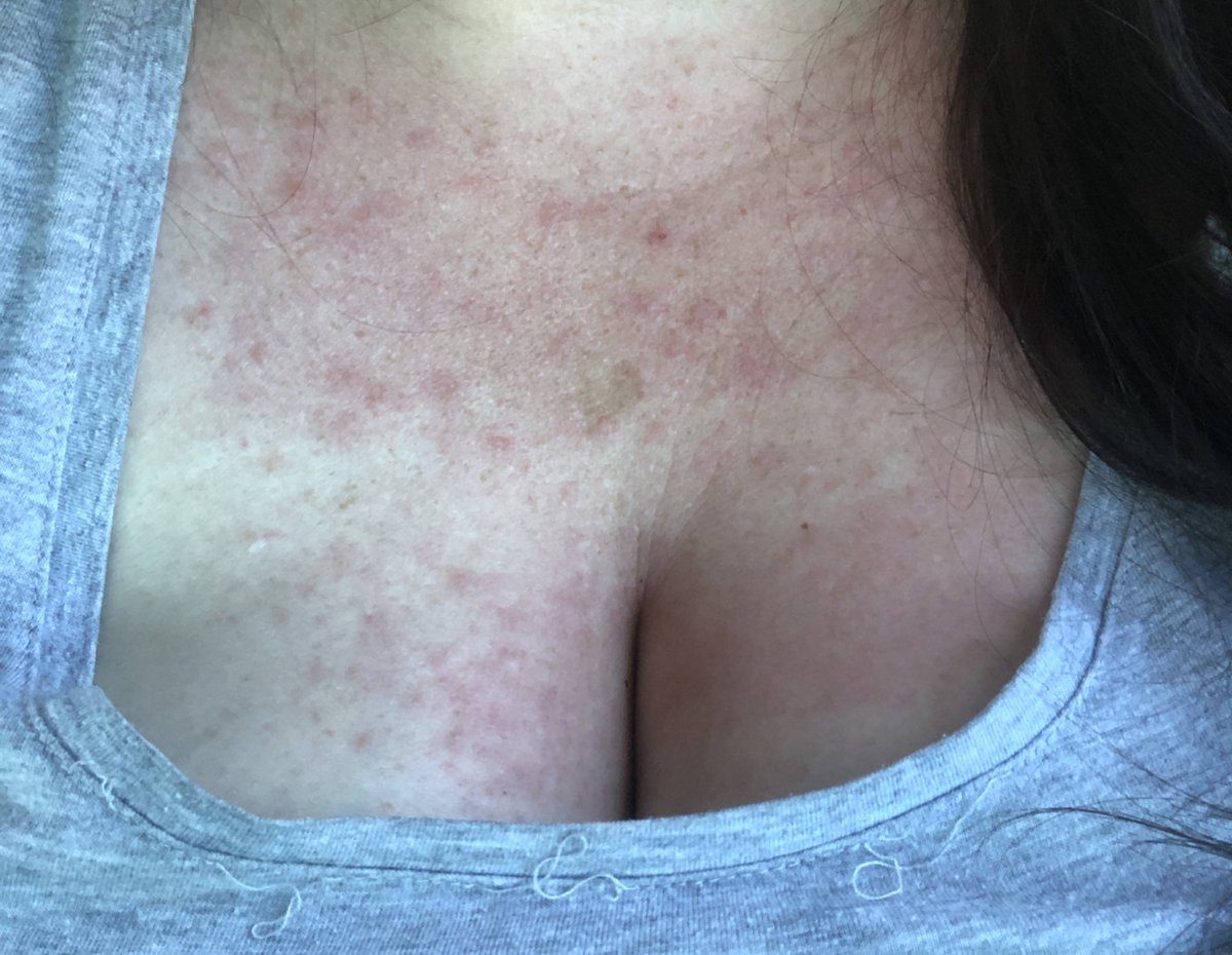 ShonnaTheWhite's tweet photo. When you get Polymorphous light eruptions, it may make you SOUND like you have a super power but I assure you, THAT’S A DIRTY LIE!!!
#paleskinproblems #ImNotAVampire #OrAmI https://t.co/yWE44a7aM4