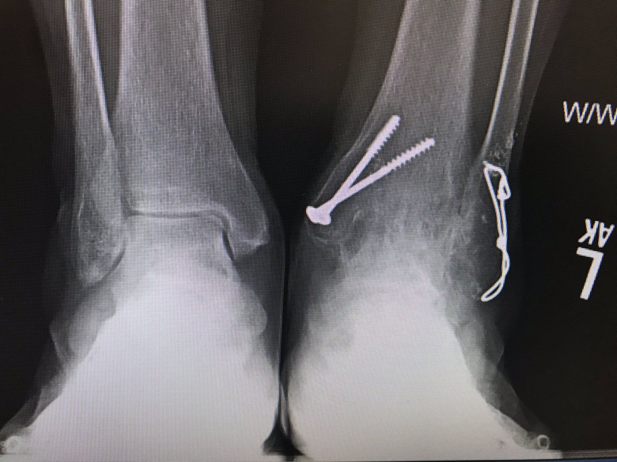 Had the chance for two year followup on a procedure that I don’t do very often: converting ankle fusion to TAA.
Fusion was remote, and her pain was both talonavicular and global metatarsalgia, with significant gait dysfunction.