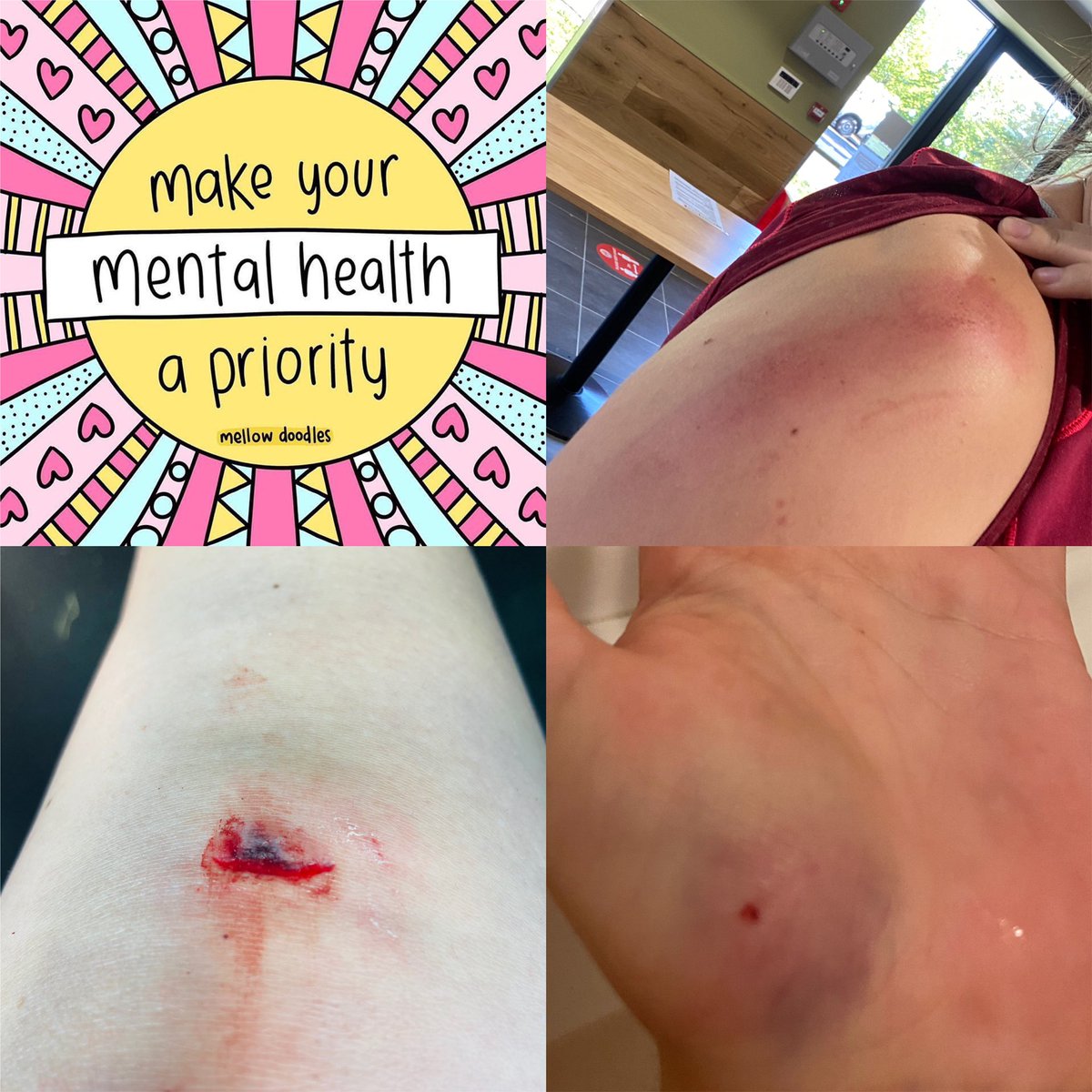 HelsMcaleese's tweet photo. Today I made my mental health a priority...possibly at the expense of physical health 🙈 Turns out I am a top notch mountain bike rider 🤔 A respectable 12km added to #keepsouthmoving but one battered body #stillagreatday #iwillnotbedefeated #ifyoufalloffgetbackon https://t.co/Phnqblv7xK