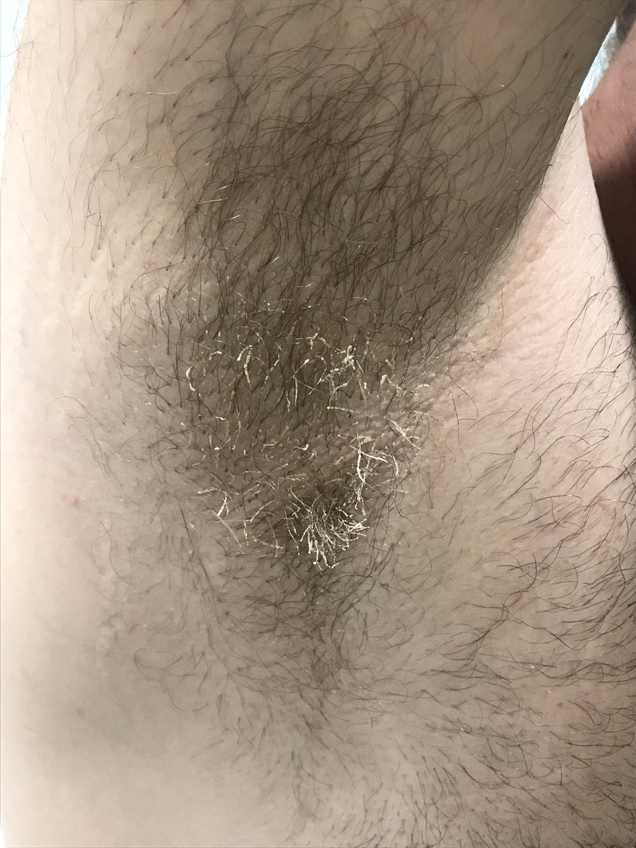 dermacrehuet's tweet photo. Scales in axillary hair 🧐🧐 clinical and #dermoscopic images #Dermatology #skin #trichology #quiz #dermatologist #physician #dermoscopy #tuesday #cordobaesp https://t.co/QV6WGQfJKk