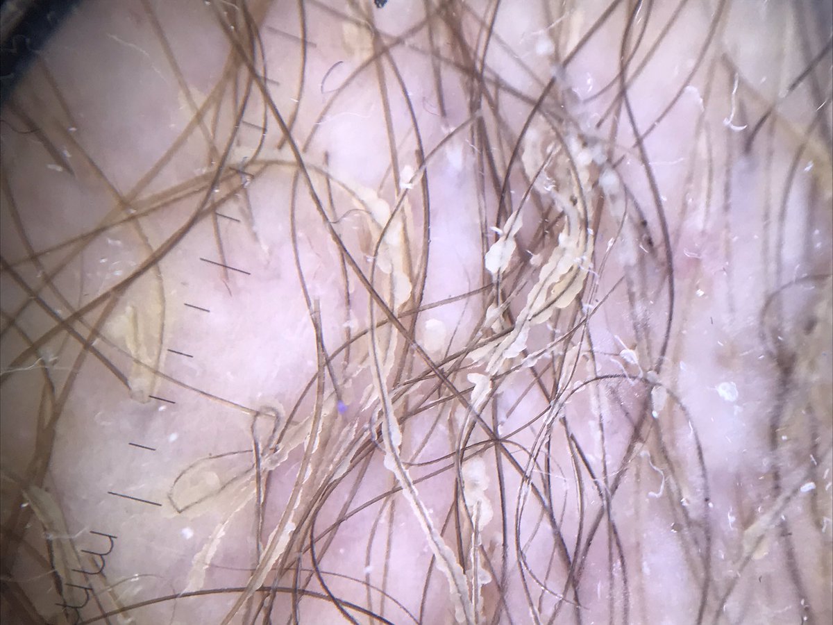 dermacrehuet's tweet photo. Scales in axillary hair 🧐🧐 clinical and #dermoscopic images #Dermatology #skin #trichology #quiz #dermatologist #physician #dermoscopy #tuesday #cordobaesp https://t.co/QV6WGQfJKk