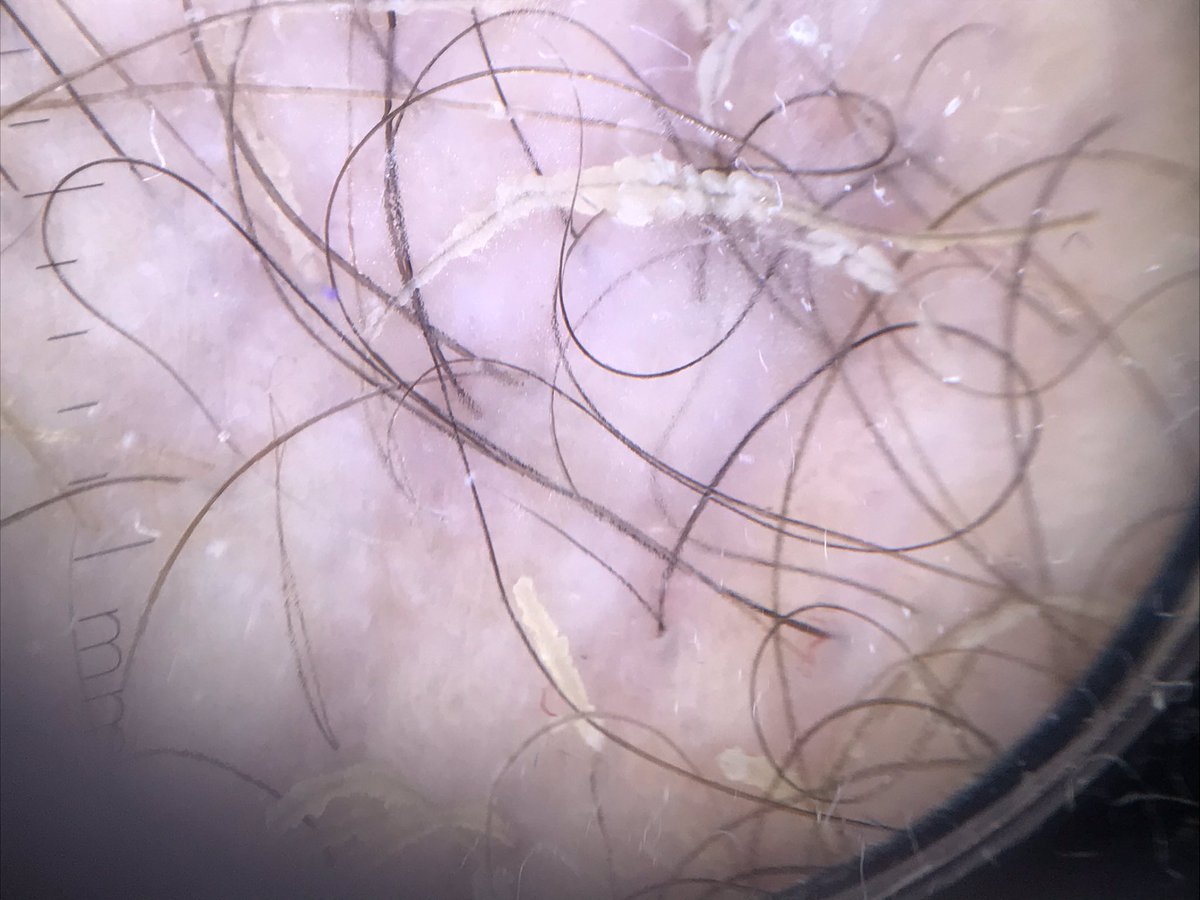 dermacrehuet's tweet photo. Scales in axillary hair 🧐🧐 clinical and #dermoscopic images #Dermatology #skin #trichology #quiz #dermatologist #physician #dermoscopy #tuesday #cordobaesp https://t.co/QV6WGQfJKk