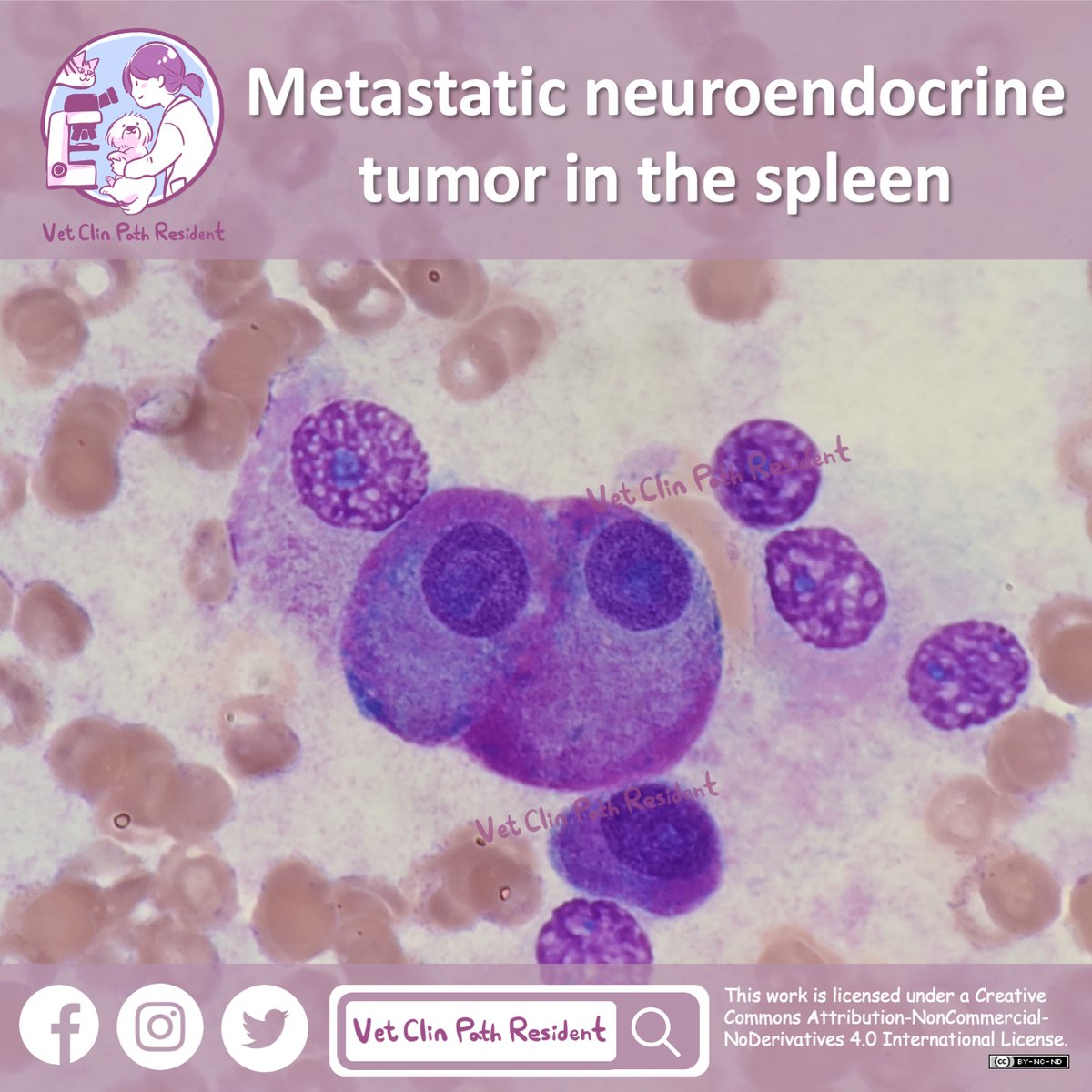 VetClinPath's tweet photo. FNA of #spleen in a 12 y/o FS Frenchie with a history of #neuroendocrine tumor (cytology: carotid body tumor) and now it mets to the spleen. You can't miss the beautiful purple granules! #cytopath #vetpathology #vetcytology #vetclinpath #ACVP #ASVCP #cytology #細胞學 #獸醫細胞學 https://t.co/C15ygoJ7nR