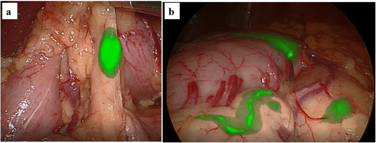polom_karol's tweet photo. new method of #sentinelnode mapping for #gastriccancer using a #fluorescent laparoscope that adjust the intensity of excitation light and quantify the intensity of #indocyaninegreen #ICG #imageguidedsurgery #casereport @ELSSurgery #visionsense @Medtronic https://t.co/tJjjSXQNu6 https://t.co/20yZhrnyhm