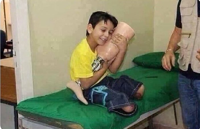 Savaşta bacaklarını kaybeden çocuğun protez bacakları hediye edildiğinde çocuğun sevinci.