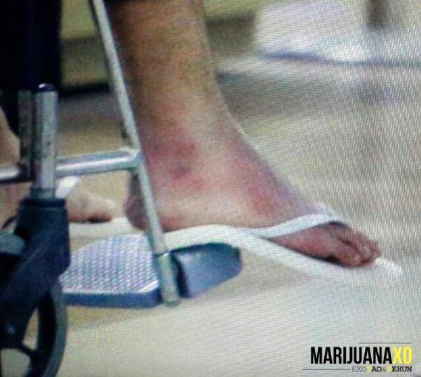 tw blood, injury tao’s foot after injuring it in law of the jungle, and during exo cmb promotions