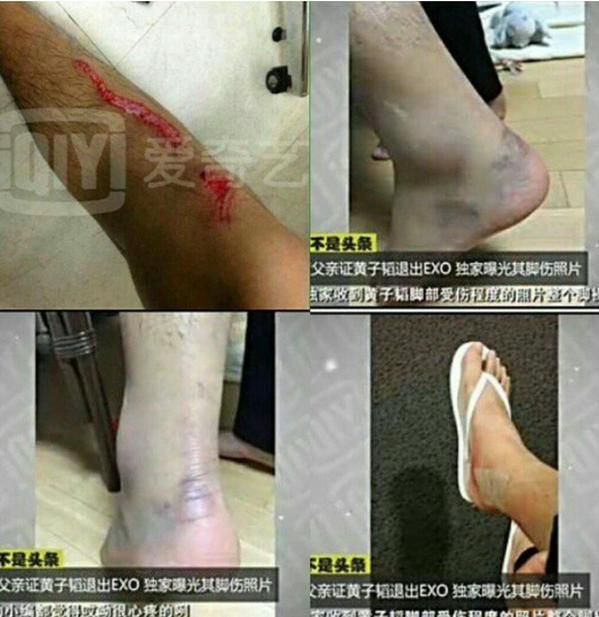 tw blood, injury tao’s foot after injuring it in law of the jungle, and during exo cmb promotions