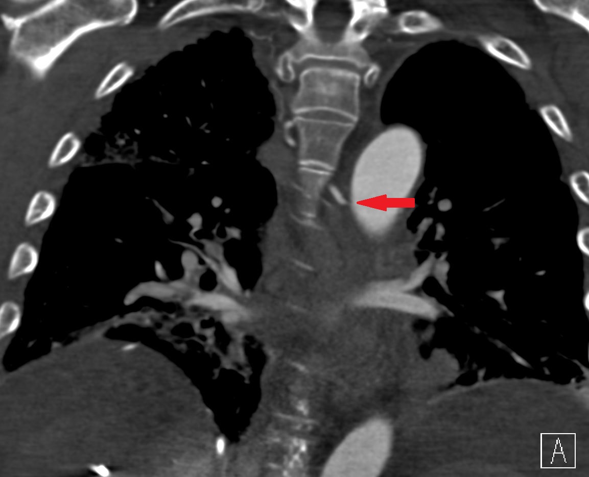 michaeldburns's tweet photo. Value of CTA prior to #embolization. Hypoxic patient with recurrent hemoptysis. 2 abnormal bronchial arteries identified on CT, from aorta but also from right subclavian.  #irad for #embolization. 500-700 mcm embospheres.
@CAIRweb https://t.co/GrWeM2MUMp