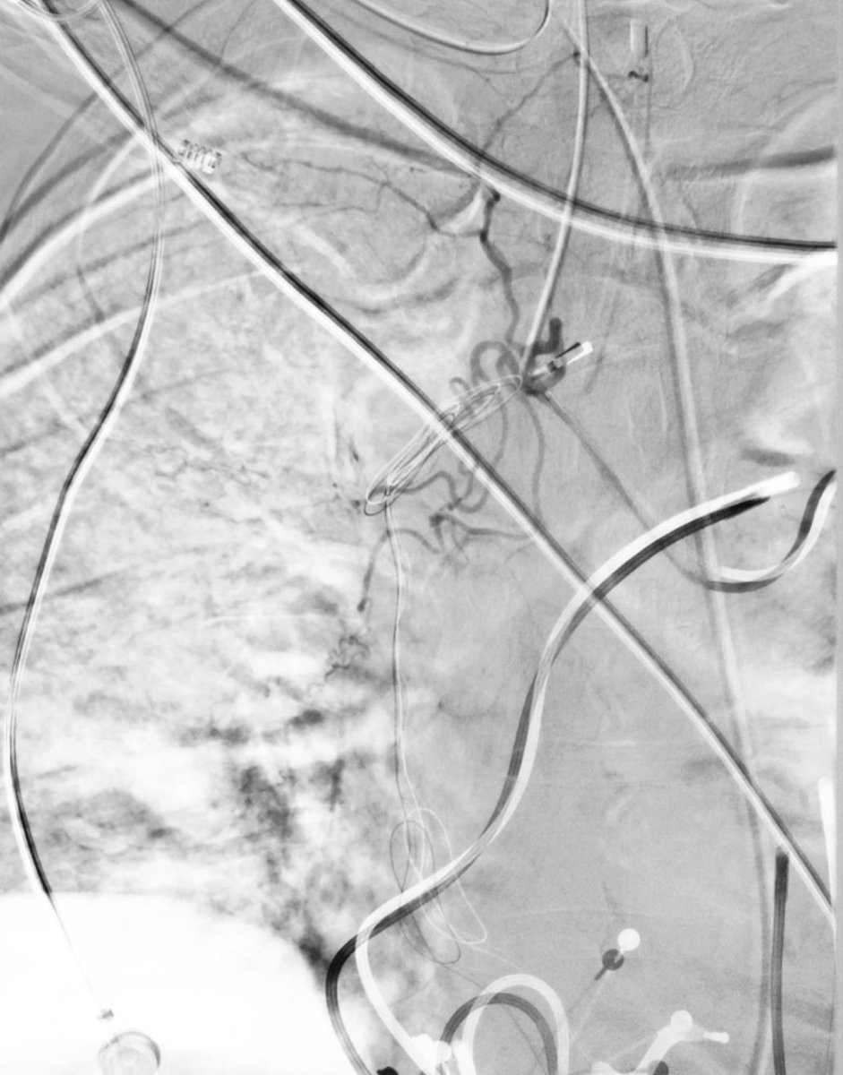 michaeldburns's tweet photo. Value of CTA prior to #embolization. Hypoxic patient with recurrent hemoptysis. 2 abnormal bronchial arteries identified on CT, from aorta but also from right subclavian.  #irad for #embolization. 500-700 mcm embospheres.
@CAIRweb https://t.co/GrWeM2MUMp