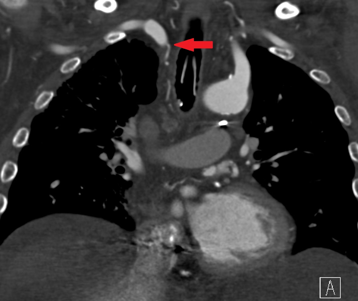 michaeldburns's tweet photo. Value of CTA prior to #embolization. Hypoxic patient with recurrent hemoptysis. 2 abnormal bronchial arteries identified on CT, from aorta but also from right subclavian.  #irad for #embolization. 500-700 mcm embospheres.
@CAIRweb https://t.co/GrWeM2MUMp