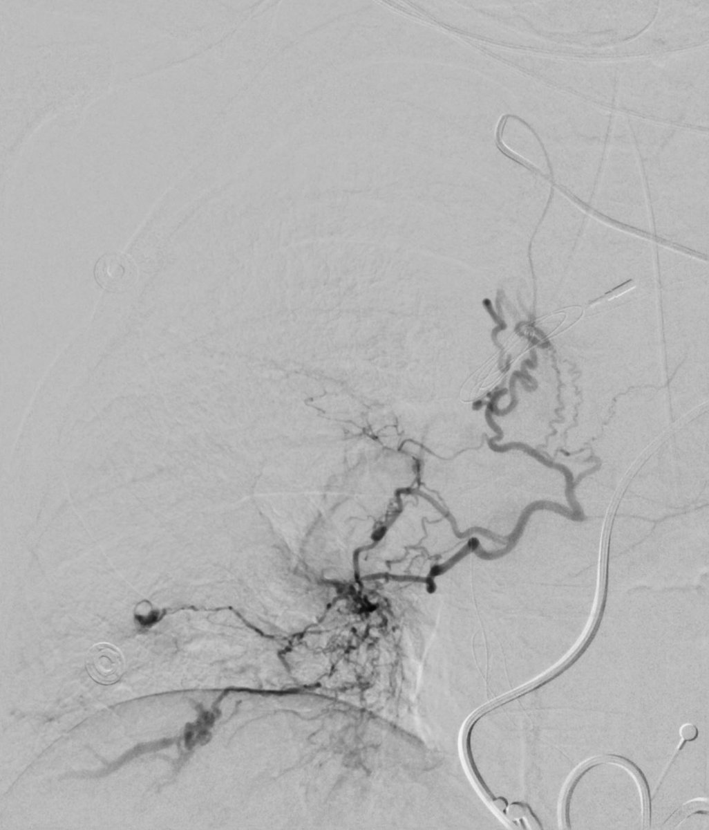 michaeldburns's tweet photo. Value of CTA prior to #embolization. Hypoxic patient with recurrent hemoptysis. 2 abnormal bronchial arteries identified on CT, from aorta but also from right subclavian.  #irad for #embolization. 500-700 mcm embospheres.
@CAIRweb https://t.co/GrWeM2MUMp