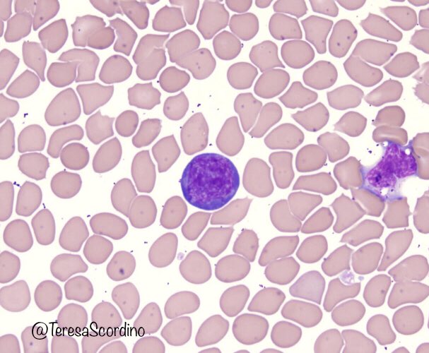 This is a large reactive lymphocyte with immunoblast morphology. The cytoplasm is deeply basophilic and the chromatin is condensed. These can be seen in viral infections, including hantavirus and COVID-19.