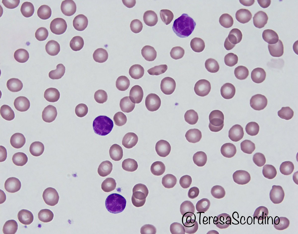 Lymphoproliferative disorders are more common in adult patients. In this older adult patient with chronic lymphocytic leukemia, the lymphocytes are small and monotonous, with scant cytoplasm and coursely clumped (“soccer ball” or “cracked mud”) chromatin.