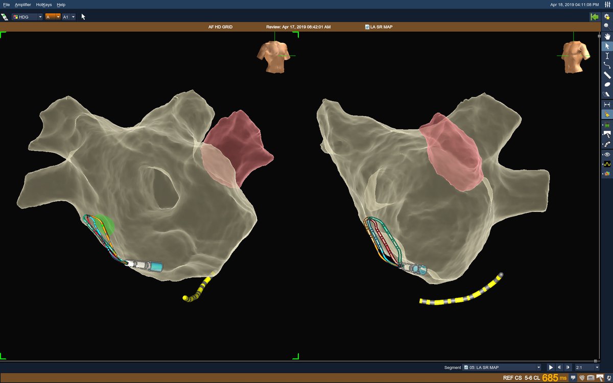 Manipulating #HDGrid in challenging spots of the left atrium. It gives visual assurance of contact due gathering of points without high force. #EPeeps <a href="/AbbottCardio/">Abbott Cardiovascular</a>