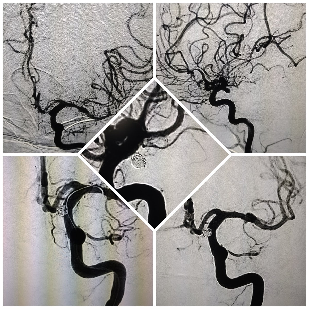withoutscalpel's tweet image. #balloonassitedcoiling #backtothecathlab
#pcom 
Its not just coiling its anti-spasmotic too