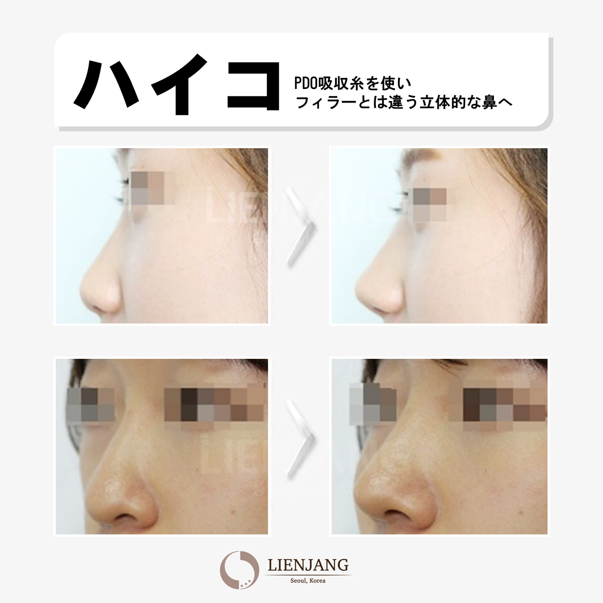 リエンジャン整形外科 鼻 を高くするには フィラー 手術以外に ハイコ という施術があることご存じですか 切開無し Pdo吸収糸を使い 鼻先 を高くシャープにする施術です 公式line Lienjangjp リエンジャン プチ整形 シロコ 韓国整形