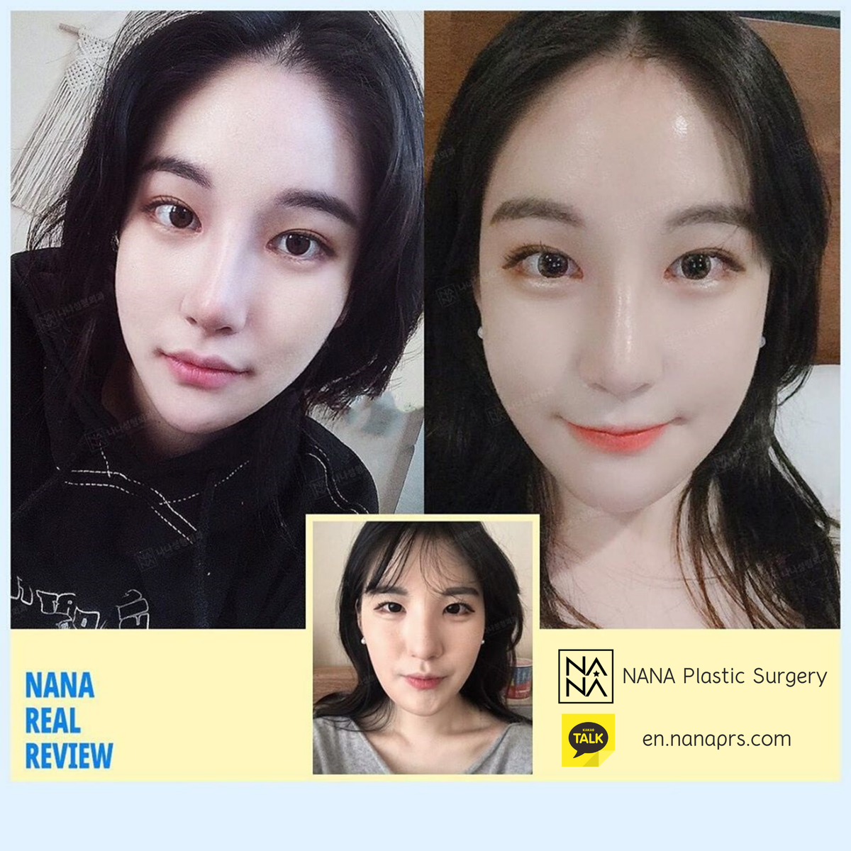 NANAHospital1's tweet image. Get a forehead lift with safe FDA approved endotine for excellent results :)