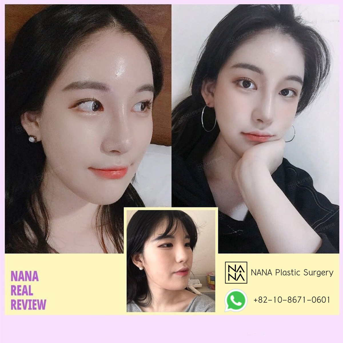 NANAHospital1's tweet image. Get a forehead lift with safe FDA approved endotine for excellent results :)