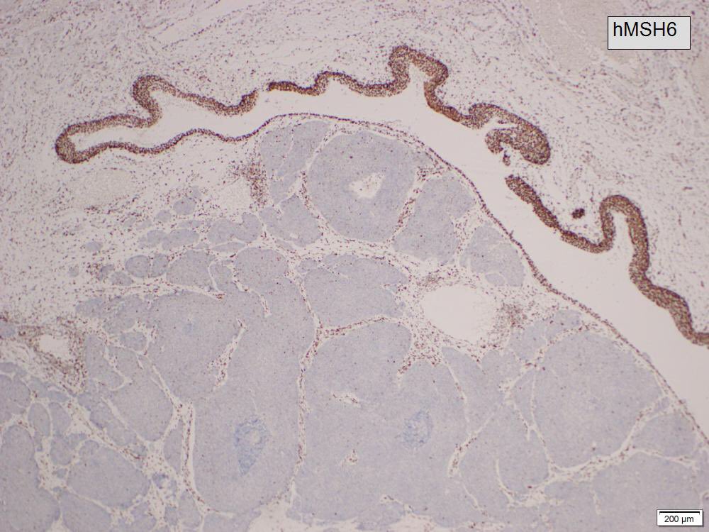 FionaMacPath's tweet photo. Lynch Syndrome and upper tract urothelial neoplasia. Usually presents later than colorectal and skin lesions, often inverted, low stage with increased intratumoral lymphocytes. https://t.co/NRbGRzejlk
