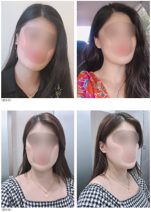 RGplastic's tweet photo. RG整形外科顔面輪郭リアルクチコミ🍑

ホームページにで沢山の症例をご覧ください💁‍♀️
https://t.co/el8p4Mlpqp

手術内容
💖Ⅴライン睡眠回し切り術
💖顎先削り

執刀医
👑RG輪郭専門医チョン院長

LINE相談 : RG_PS

#エラ切リ　#RG顔面輪郭DT　#cctv安全区　#顔面輪郭症例　#エラ縮小術 https://t.co/dggM6oQxs0