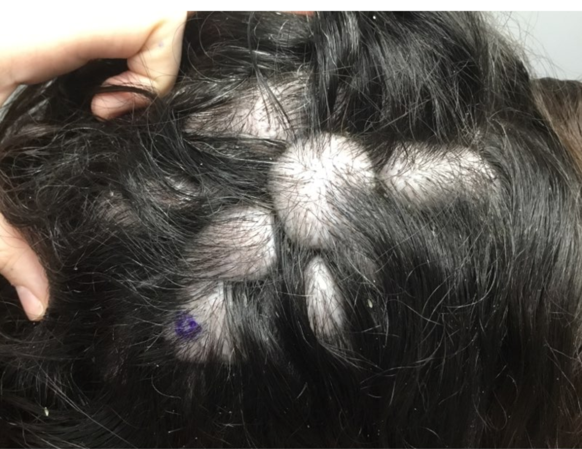 Research in HIV on Twitter: "The presence of other #sexually #transmitted  #infections (STIs) may also increase a person's risk of #hair #loss. STIs  such as syphilis, gonorrhea, and herpes often co-occur in