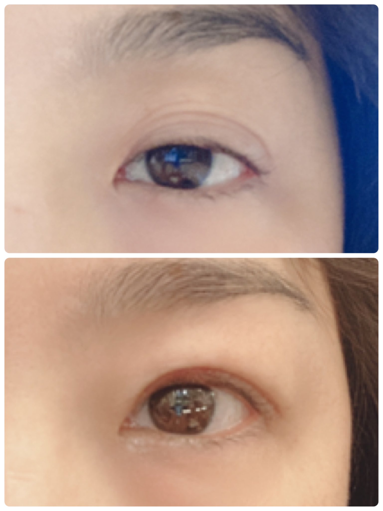 Harumi 眼瞼下垂 の手術を終えました 直前直後写真 むくみはあるけど内出血も最低限 赤くもならず 直後なのにパッと見には手術した事も分からないくらい 手術前はこれでも全力で眼を開いてるんだけど 自力ではこれが限界だし 目蓋が三重に 術後は力ま