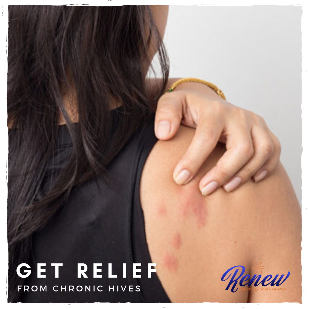 Hives are itchy welts on the skin. They can be caused by
an allergic reaction. A thorough medical exam can help rule out possible causes, such as an infection or medication. 

#hives #skincondition #skincare #dermatologyjamaica #jamaicandermatologist #renewdermja