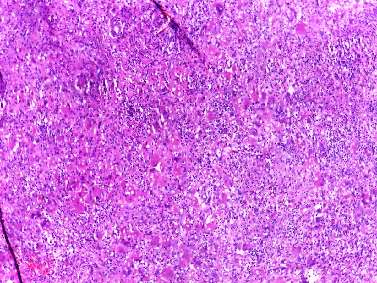 deedee2984's tweet image. Fungating chest wall mass. What do u see? 😊 #pathology #TropicalPath @DrGeeONE @TheKarenPinto @smlungpathguy @Aisha_Nabila09 @drlawalm @JMGardnerMD @nusrat_xahra