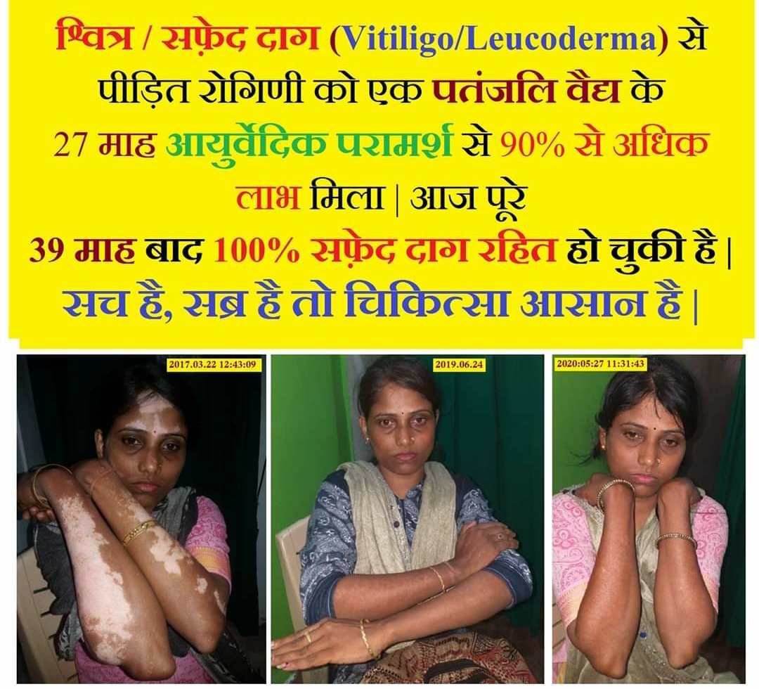 Pabitra86808816's tweet image. #श्वित्र #Leukoderma
#आयुर्वेद एक मात्र ऐसी चिकित्सा पद्धति है जिसमे श्वित्र पूरी तरह चला जाता है 
संलग्न केस में पतंजलि योगपीठ के #दिव्य_फार्मेसी द्वारा निर्मित आयुर्वेदिक औसधियों मात्र से निदान परिवर्जन करते हुयें रोग पूर्ण रूपेण ठीक हो गया है
@yogrishiramdev 
@Ach_Balkrishna