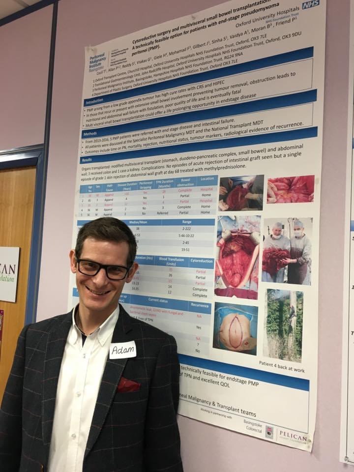 AdamAlderson3's tweet photo. With me now 5 years clear of #Pseudomyxoma following Modified Multi Visceral #Transplant why are we not seeing other countries doing the same for #PMP patients with no good options? @SPeritoneum @BasingstokePmi @acpmpresearch @Dukes_Club @merakoiacademy #lifeonextratime #cancer https://t.co/k9F08eGS3c