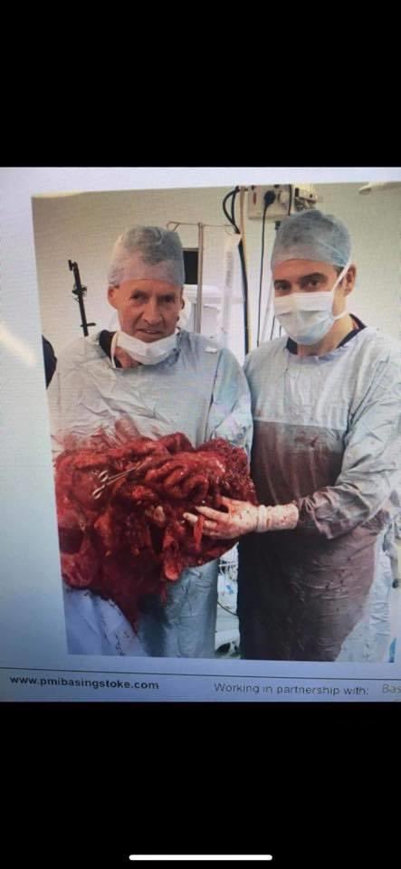 AdamAlderson3's tweet photo. With me now 5 years clear of #Pseudomyxoma following Modified Multi Visceral #Transplant why are we not seeing other countries doing the same for #PMP patients with no good options? @SPeritoneum @BasingstokePmi @acpmpresearch @Dukes_Club @merakoiacademy #lifeonextratime #cancer https://t.co/k9F08eGS3c