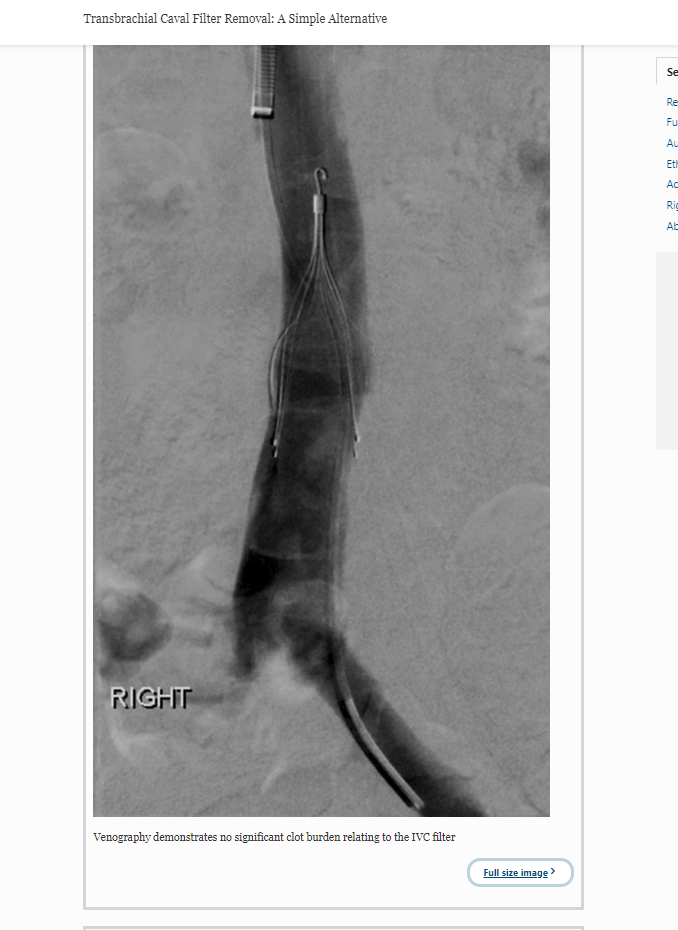 CVIR_Journal's tweet photo. Transbrachial Caval Filter Removal: A Simple Alternative
#VCfilter #IRad
https://t.co/n2GRd1h8K2 https://t.co/XQyNuhfYuH