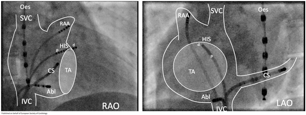 Review in detail the diagnosis, acute, and long-term treatment of atrioventricular nodal reentrant #tachycardia bit.ly/3hrSw5b

#EPeeps <a href="/tomdepotter/">Tom De Potter</a> <a href="/TJ_Yeo/">Tee Joo YEO</a> #cardiotwitter #EHJCaseReports <a href="/johncamm/">Mohammed Ali</a>