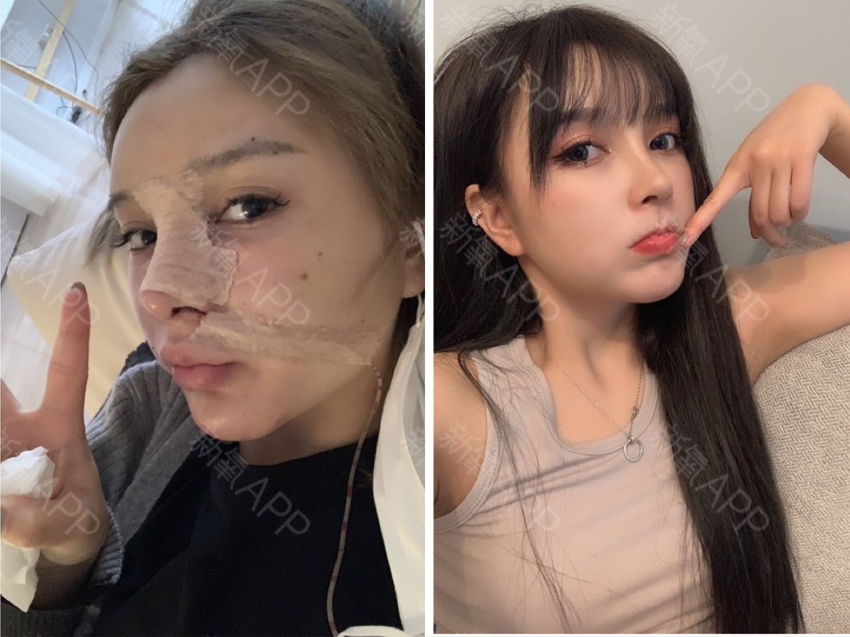 meirong3333's tweet photo. どの角度から見ても自然な立体感を実現し、 
正面からも側面からも、
自然な美しい鼻先になりましたね！😯

#整形垢さんと繋がりたい #美容垢さんと繋がりたい https://t.co/QRV5b4OGgY