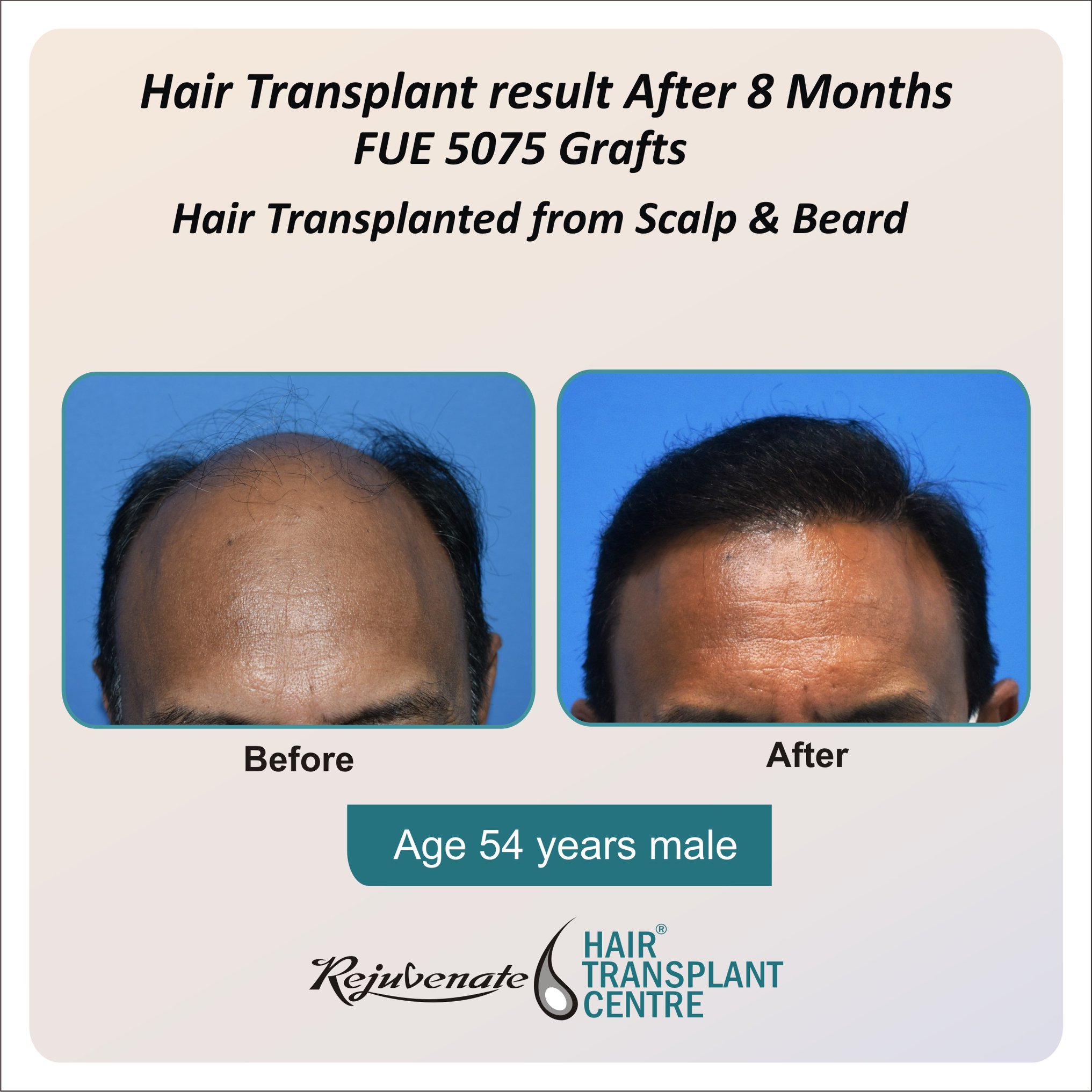Rejuvenate Hair Transplant Centre on Twitter: Rejuvenate Hair Transplant Centre on Twitter: