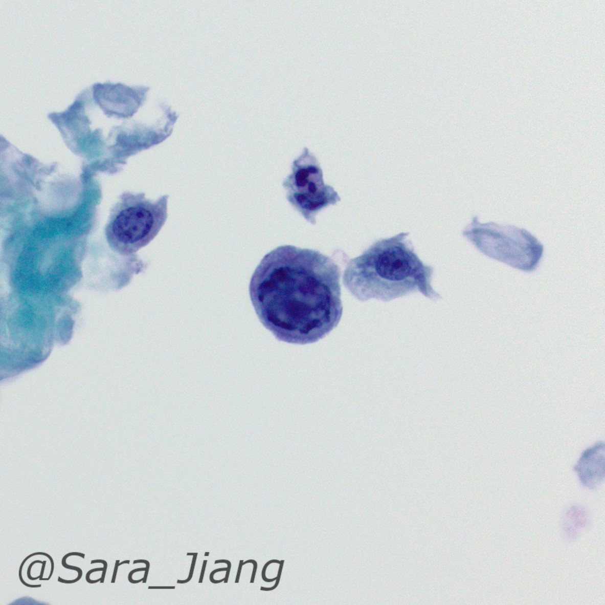 #CytoABCs!
J is for JC virus, polyoma virus (BK is the other more common one) causing viral cytopathic effect in urine
Termed Decoy cells due to mimicking HG urothelial CA: 
➡️Enlarged nuclei
➡️Clumpy chromatin 
➡️Glassy nuclear inclusions
➡️Elongated comet-tail cytoplasm
