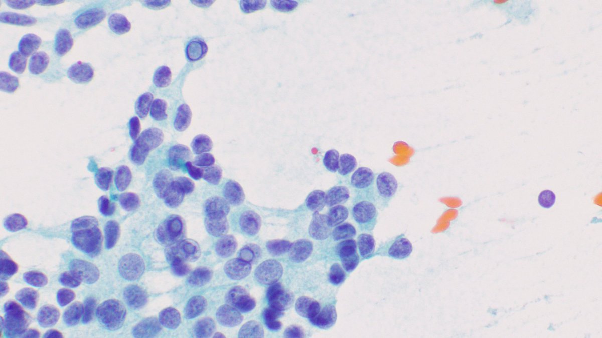 Don't let the intranuclear inclusions fool you! Medullary carcinoma can have them too 😮 (this case fooled me though😐- check out the powdery chromatin and nuclear groves..but this is a recurrence in a proven case of medullary carcinoma in a 12 year old).