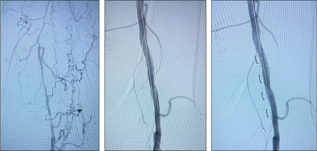 IntactVascular's tweet photo. Thanks to Dr. Dishmon and the team @MethodistHlth South for sharing their successful case using the Tack Endovascular System® (6F). CTO of SFA, Hawk ATX followed by IN.PACT™ Admiral™ DCB. 4 Tacks placed in P1 #oPTA #TackitUp #savelimbs #CLI https://t.co/1LyPaxA4O5