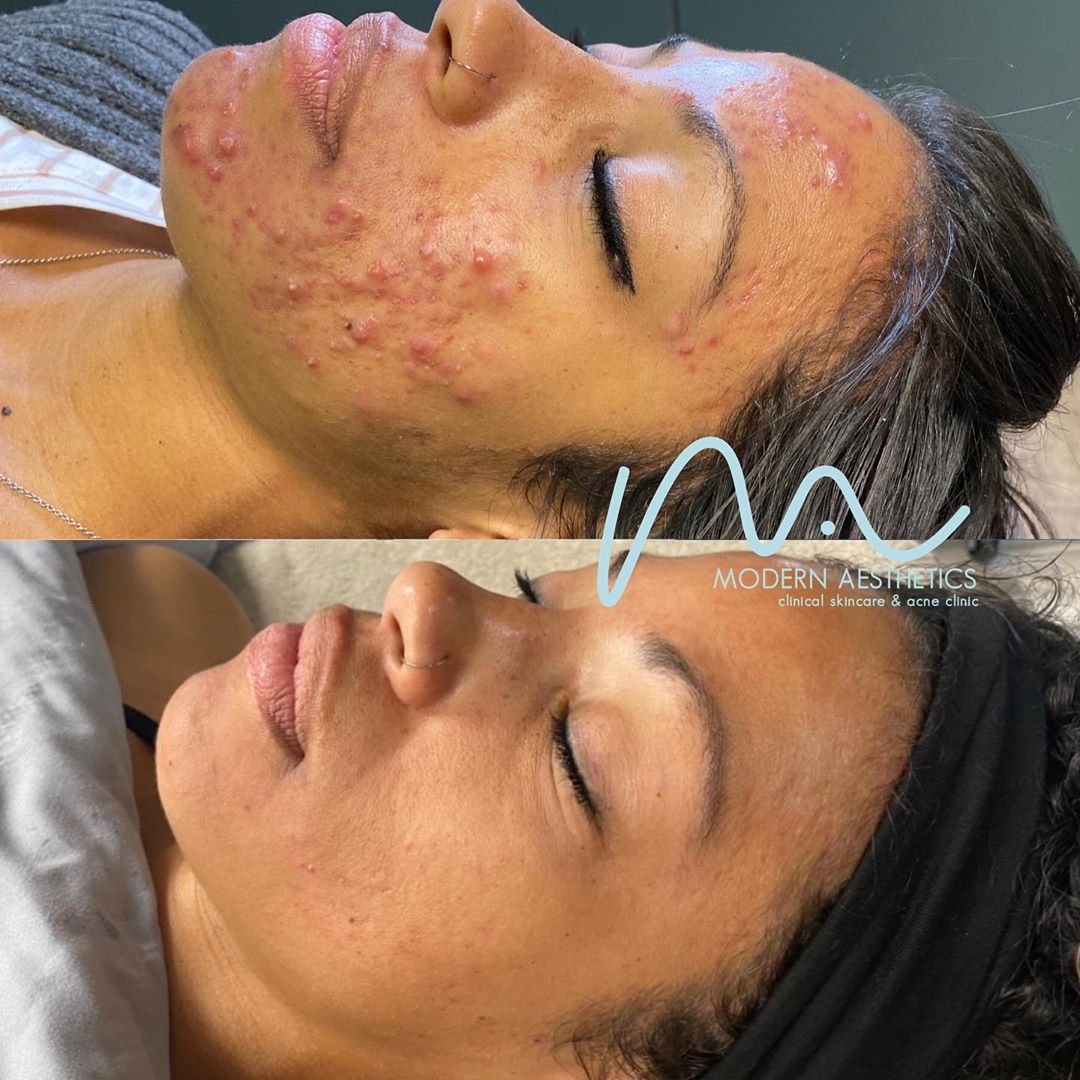 FaceRealityAcne's tweet photo. Incredible client results brought to you by Face Reality Acne Expert @modernaestheticsec . With the right guidance, lifestyle choices, and treatment plan your #skingoals are possible! Visit the link in bio to start your skincare journey today!✨ https://t.co/rT6TGVzbsw